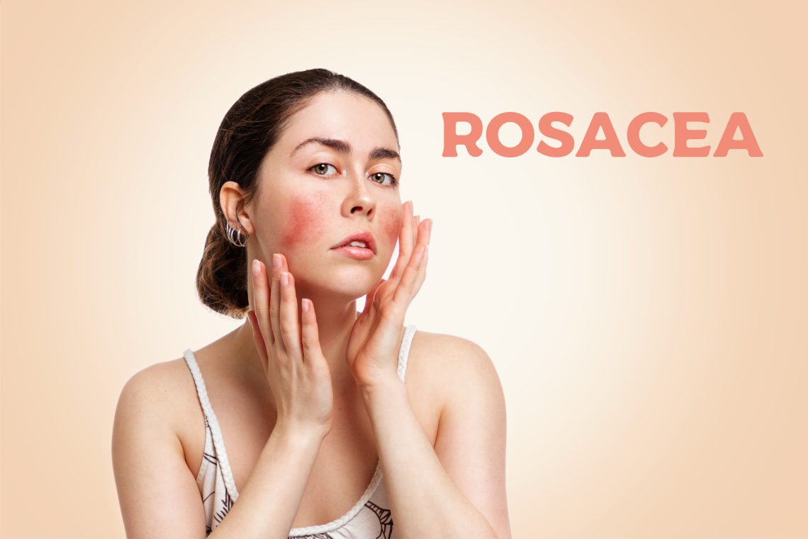 What is rosacea caused from