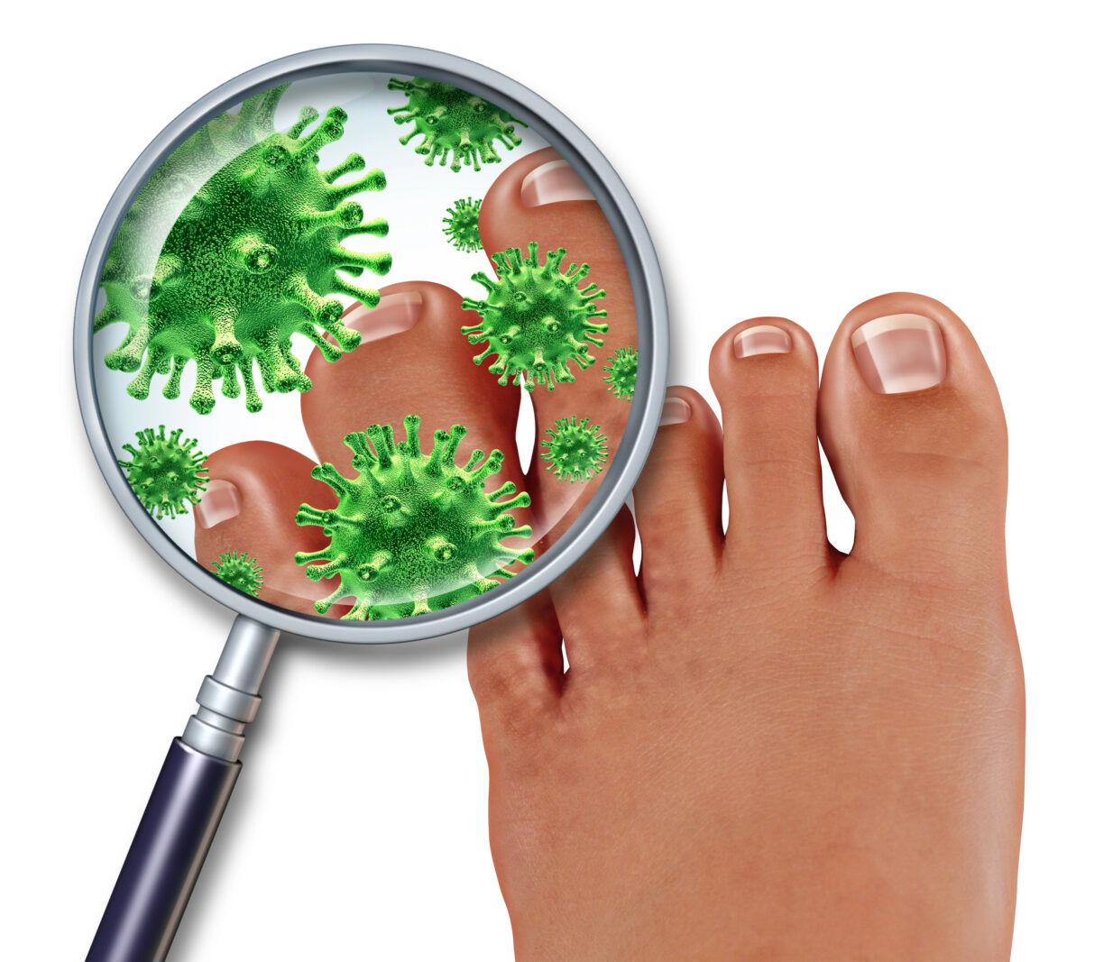 The Ultimate Guide To Fighting Fungal Nail Infections At Home Clich