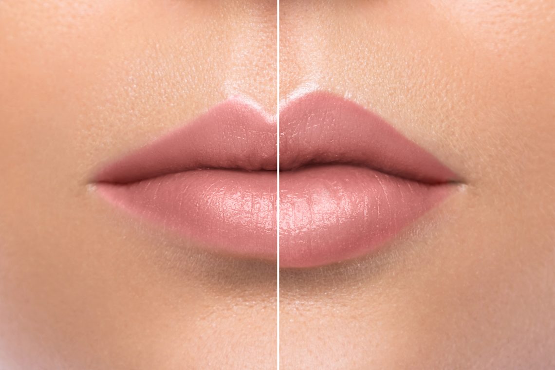 getting lip fillers