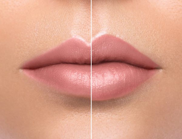 getting lip fillers