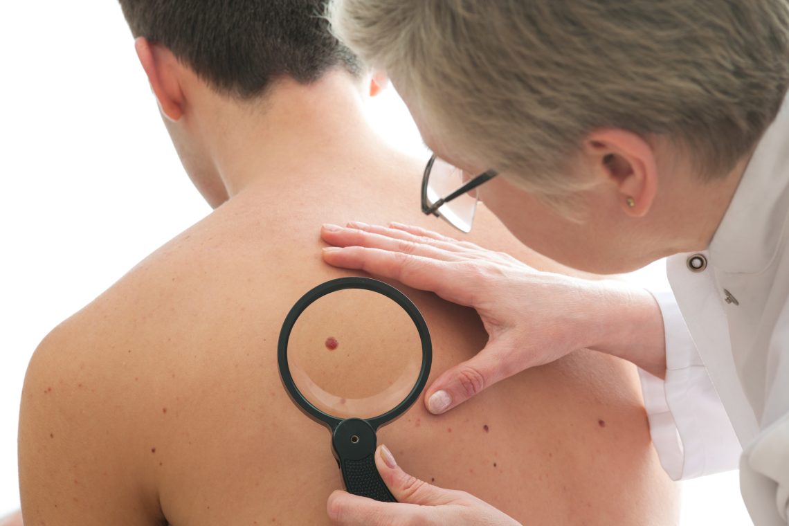 mole removal
