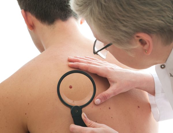 mole removal