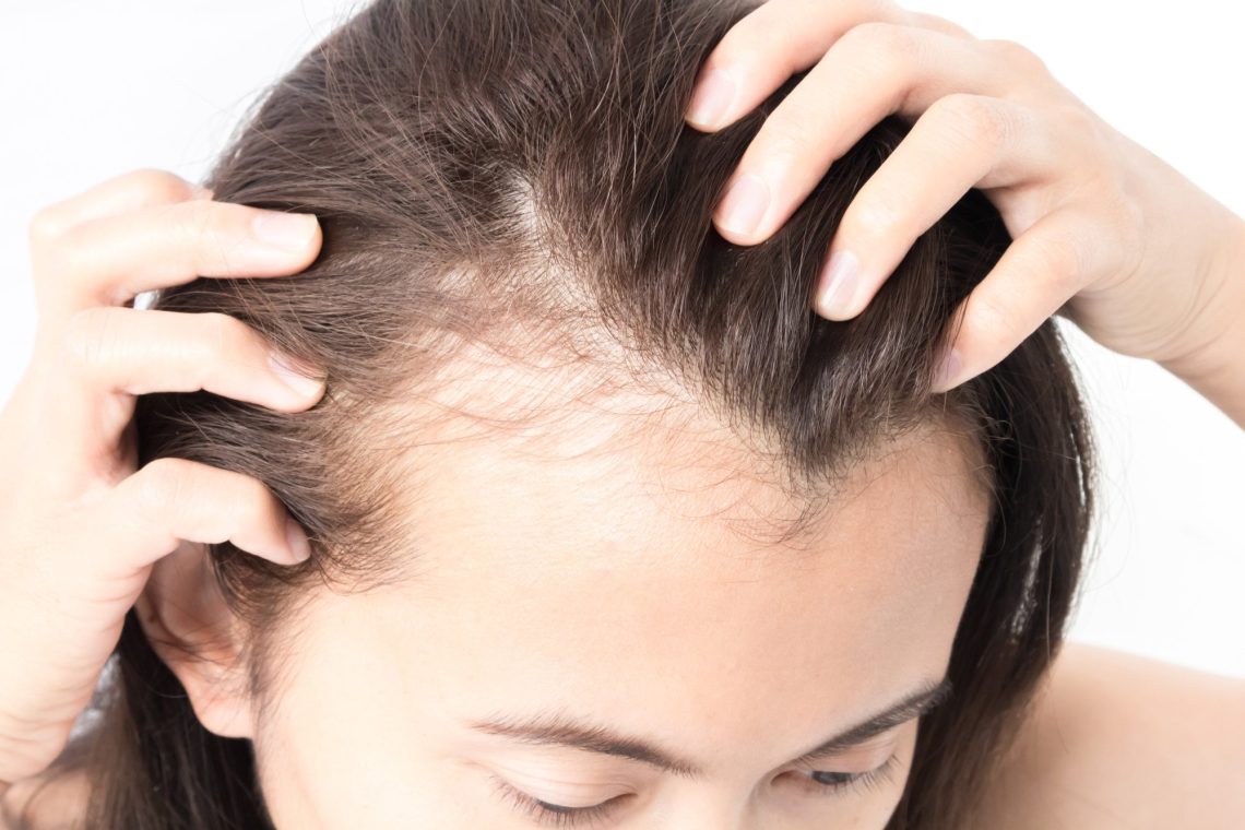 Hair Replacement vs Transplant