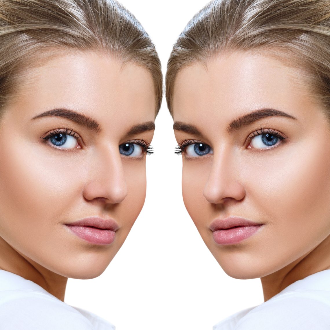 before and after rhinoplasty