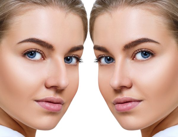 before and after rhinoplasty