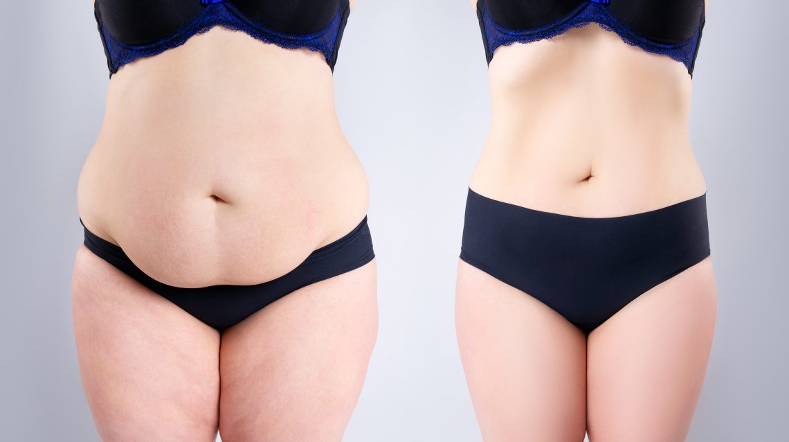 before and after tummy tuck