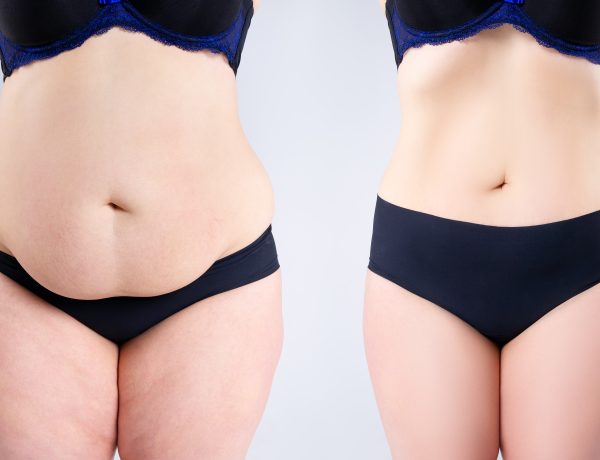before and after tummy tuck