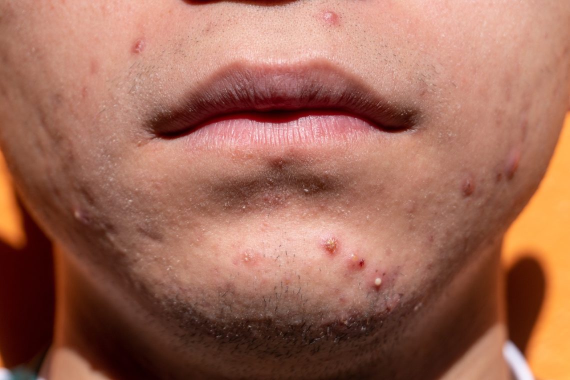 What is Acne