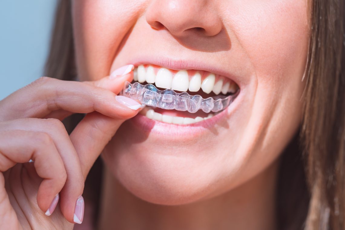 Invisalign versus traditional braces