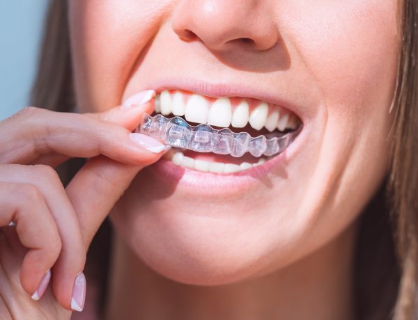 Invisalign versus traditional braces