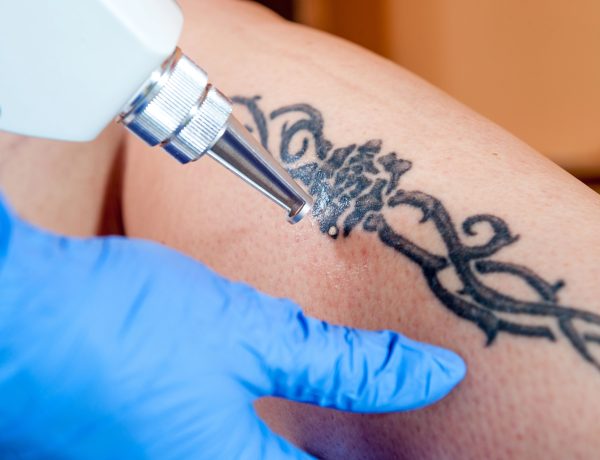 tattoo removal