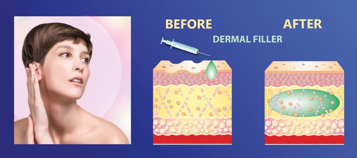 types of dermal fillers
