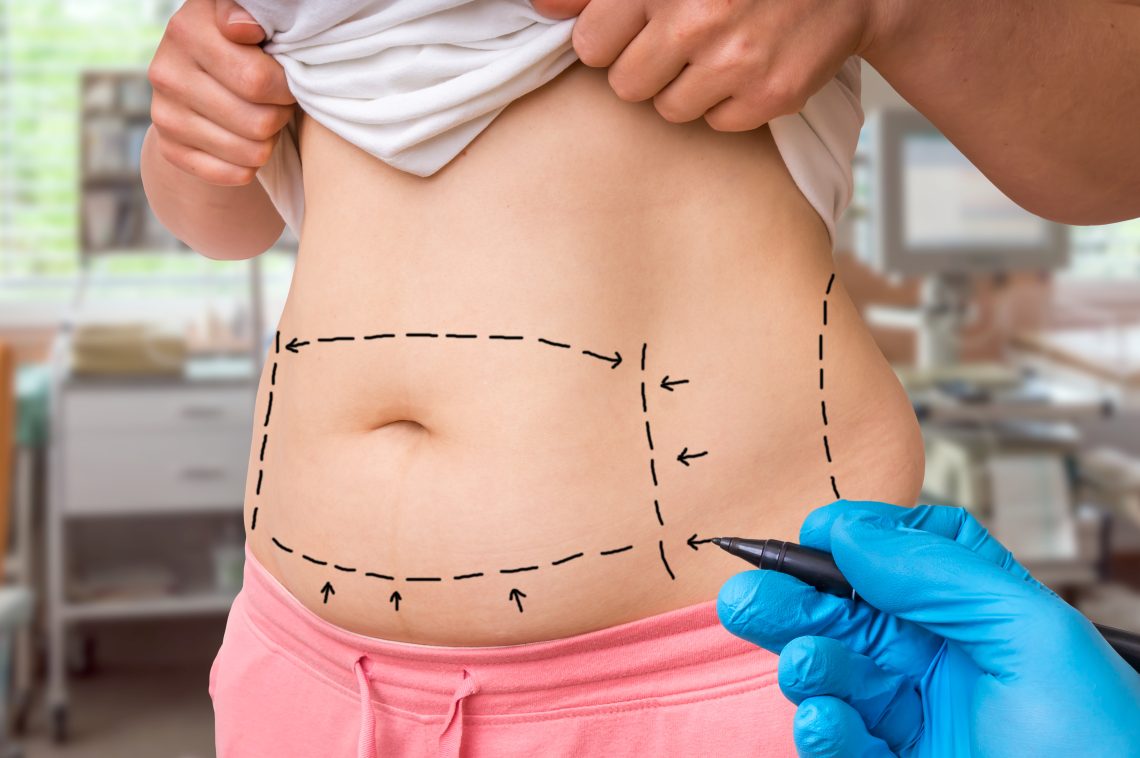 Benefits of Tummy Tuck