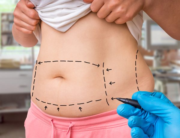 Benefits of Tummy Tuck