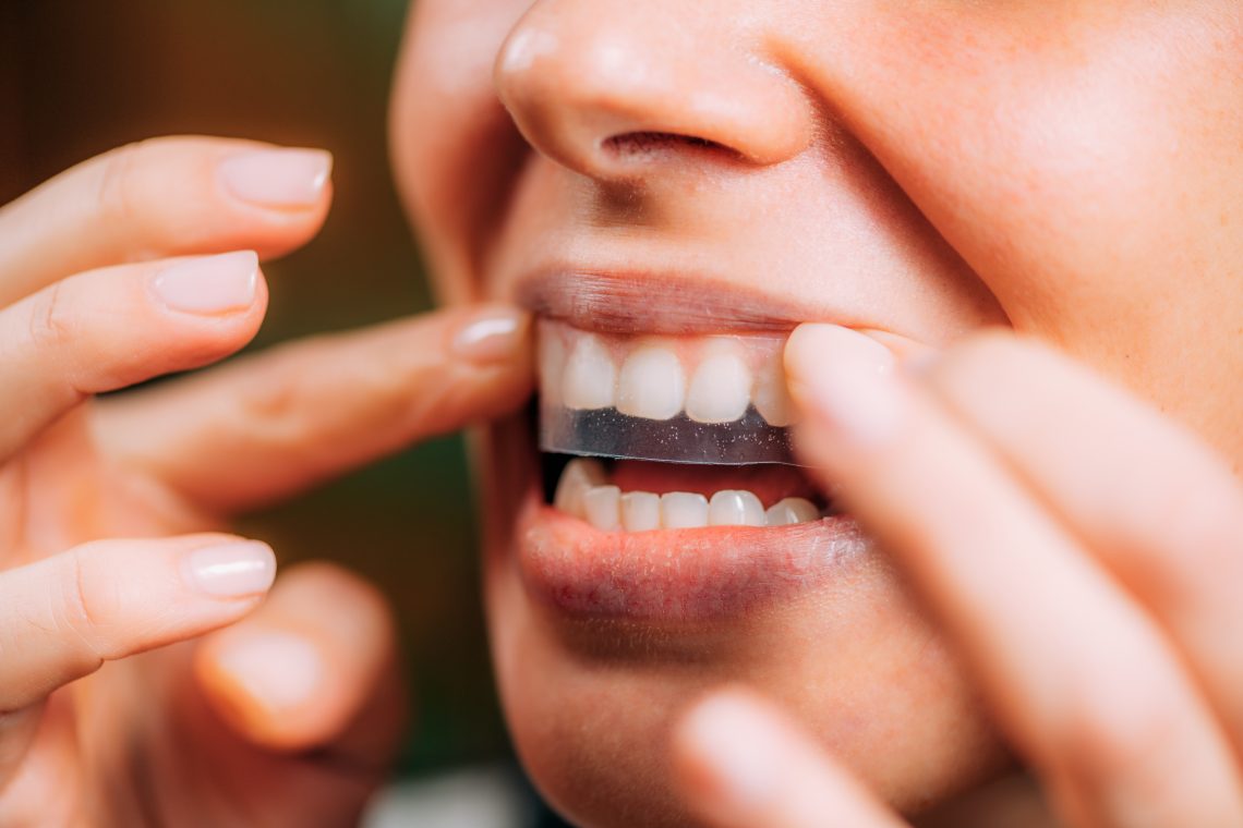 whitening strips