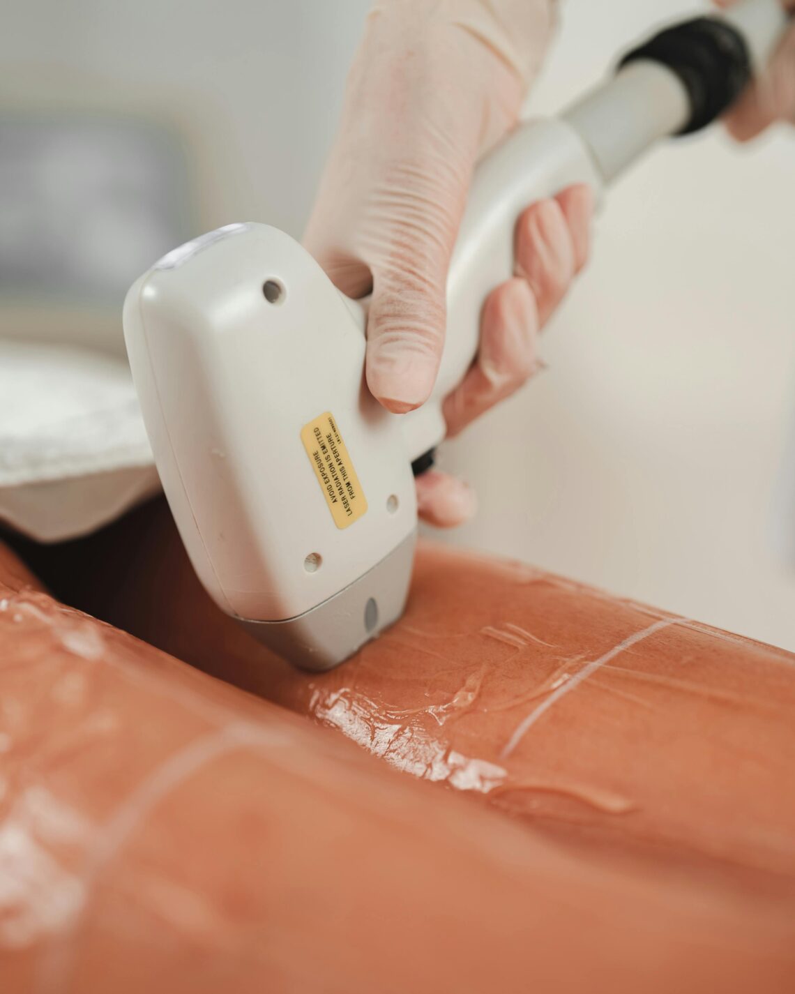 laser hair removal