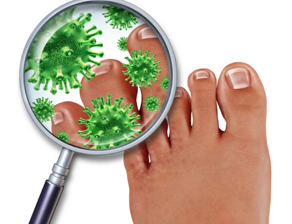 Fungal Nail Infections