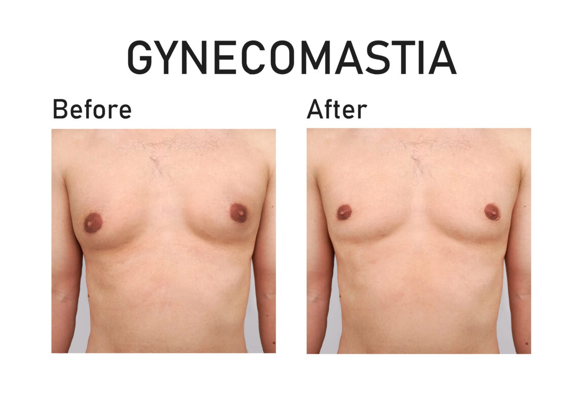 Gynecomastia Surgery