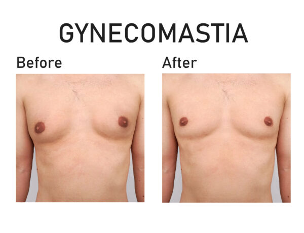 Gynecomastia Surgery
