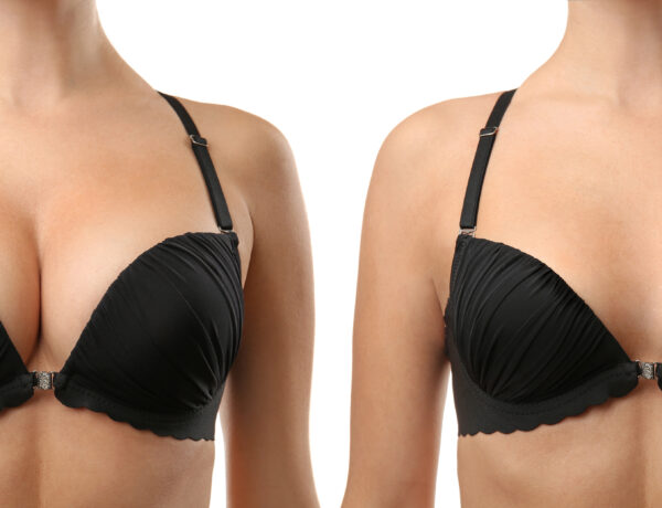 breast reduction surgery