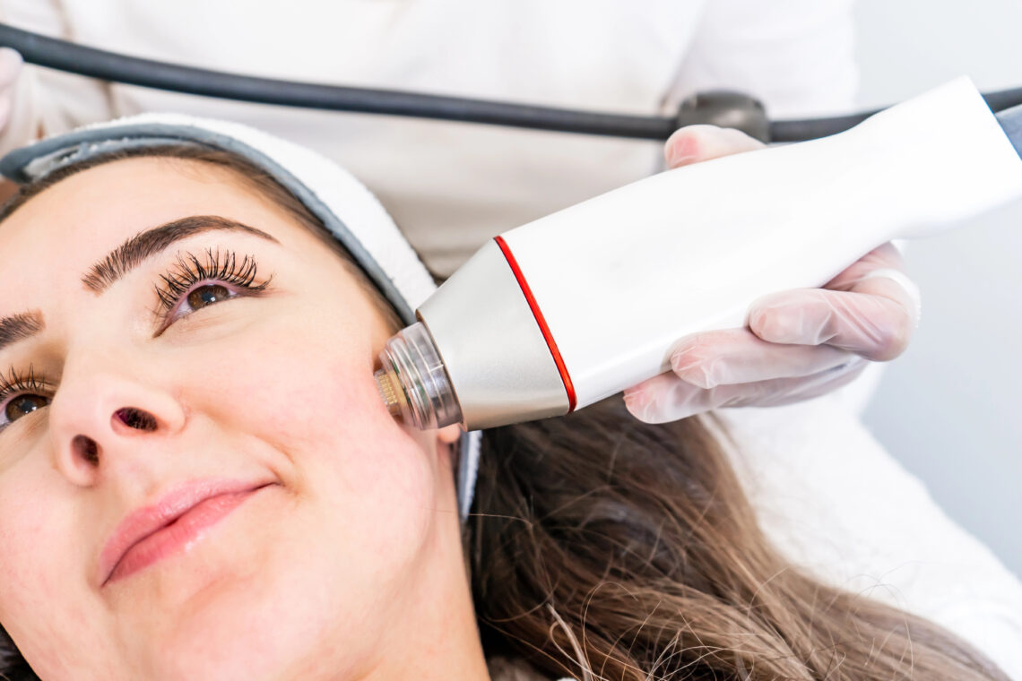 RF Microneedling