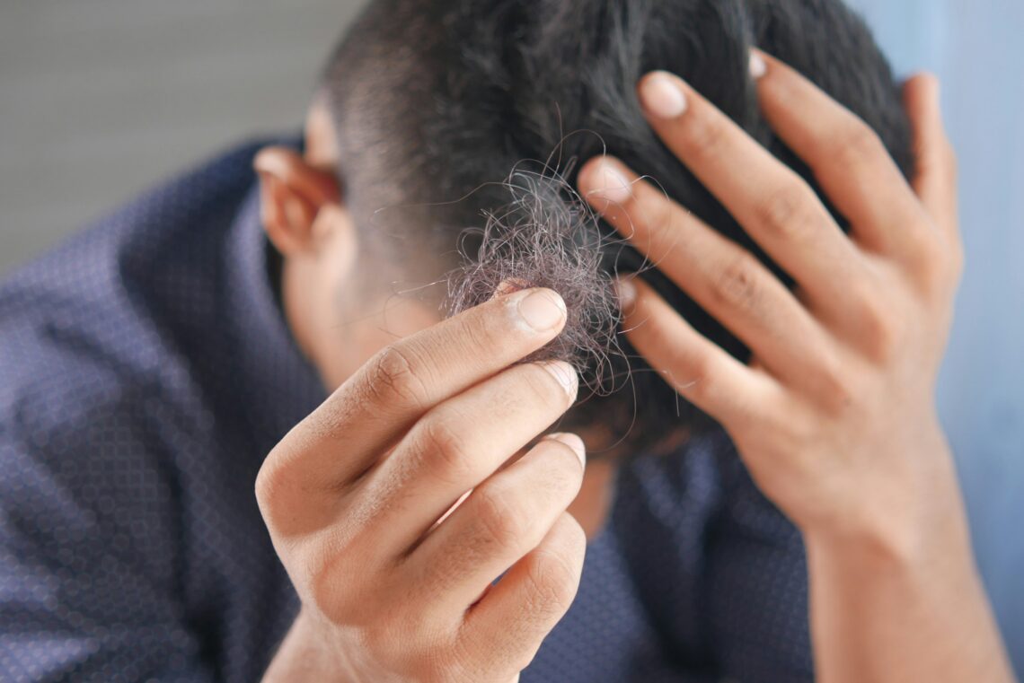 Hair Loss Treatments in India