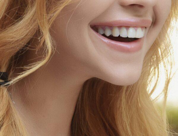 porcelain veneers