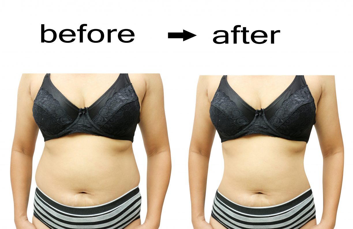 Questions About Liposuction