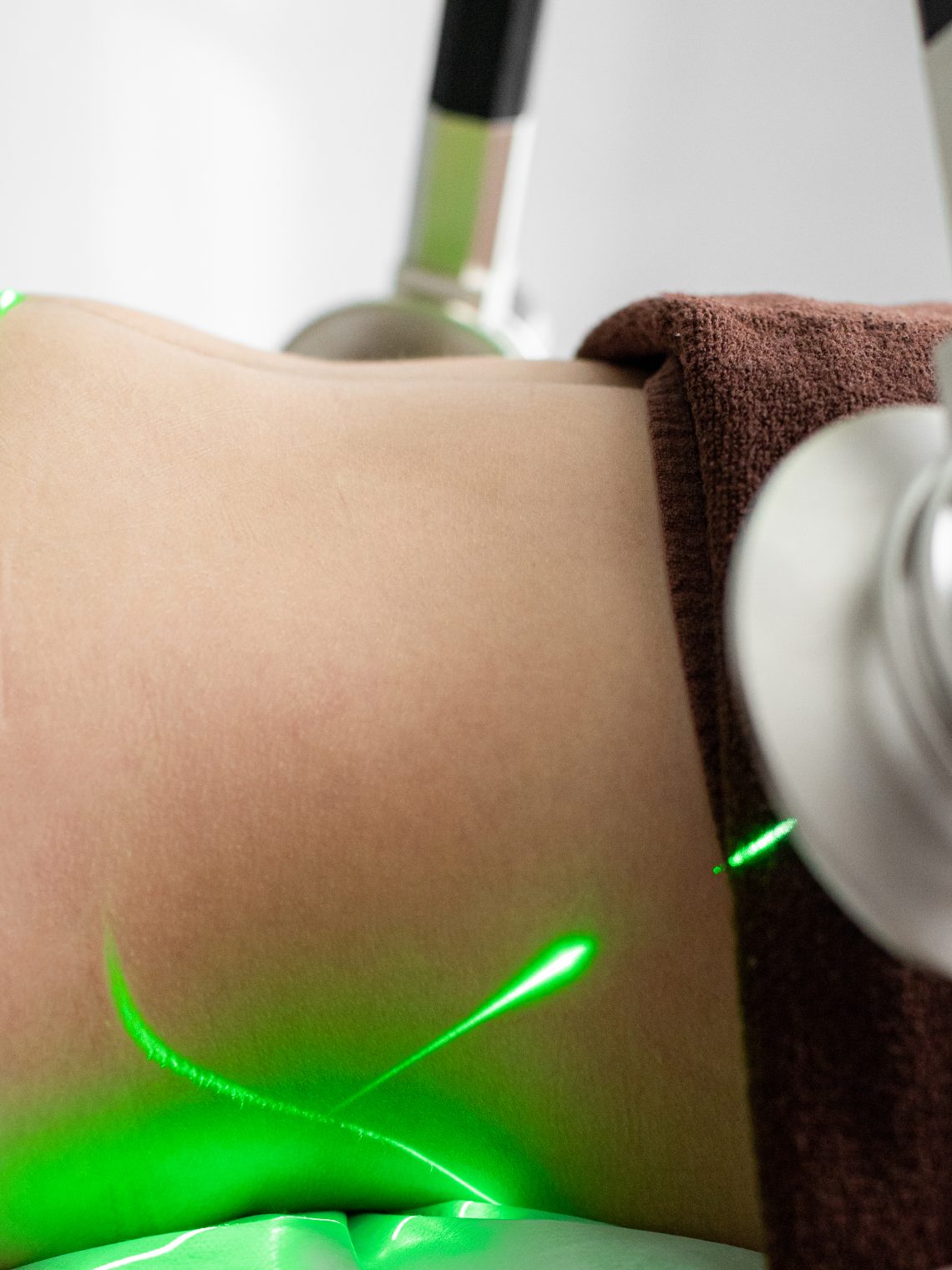 Laser-Assisted Lipolysis with EndoDefine: A Modern Approach to Fat Reduction