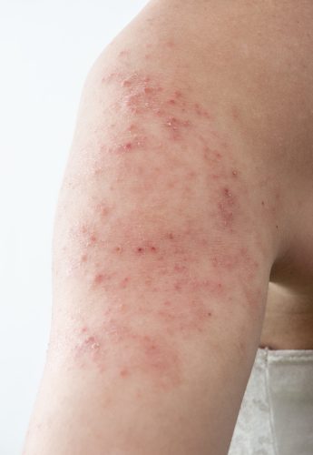 allergic rash dermatitis