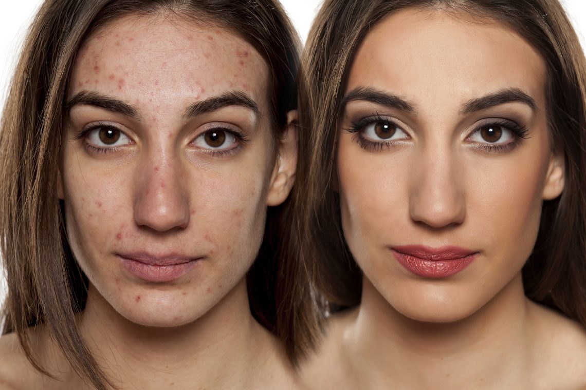 problematic skin before and after makeup