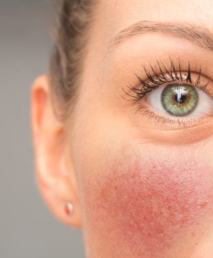 What is rosacea caused from