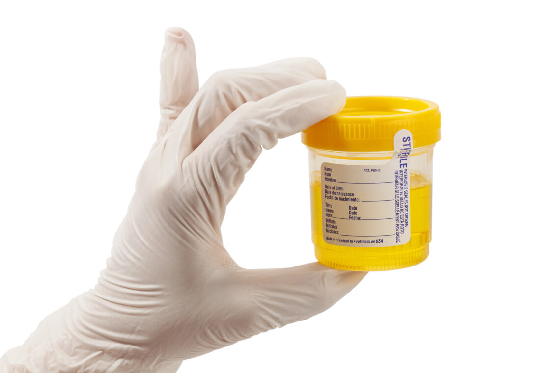 What are the Differences Between Lab-Based and Instant Urine Drug Tests? Understanding Testing Methods