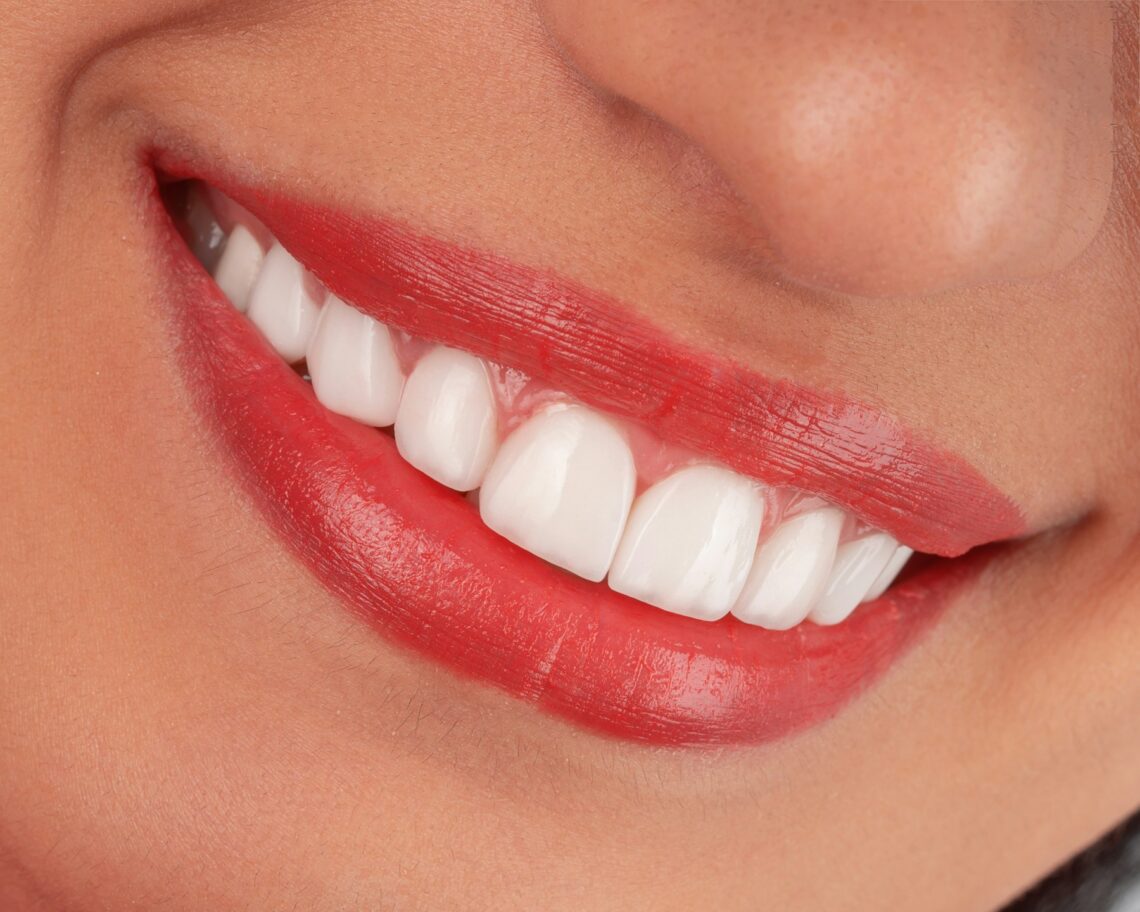 dental veneers in Coral Springs