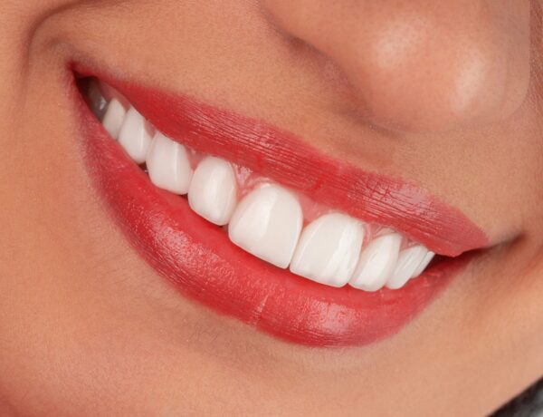 dental veneers in Coral Springs