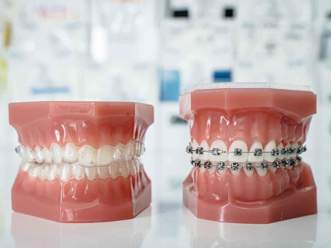 The Quiet Confidence Shift That Happens When Your Teeth Start Moving