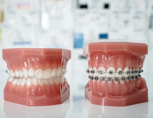 The Quiet Confidence Shift That Happens When Your Teeth Start Moving