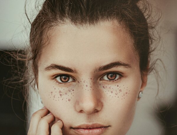 What are Dark Spots and how to Fade Them?